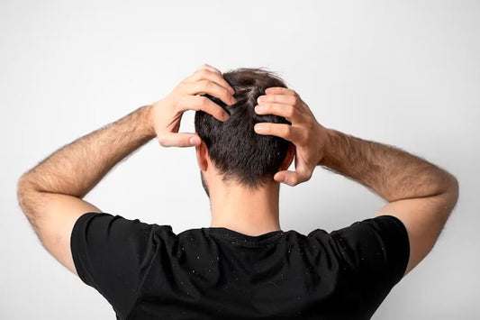 How to Tackle Dandruff with the Best Shampoo for Men: Expert Tips